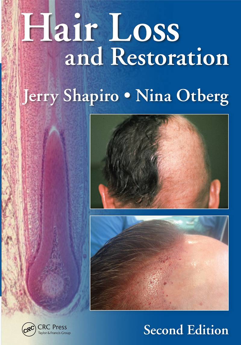 Hair Loss and Restoration 2nd Edition